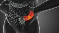 Colon cancer